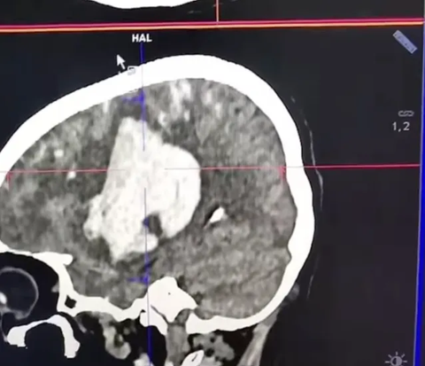 CT Scan Penggila Kopi dan Bergadang Bikin Takut Warganet, Usia 30 Pendarahan Otak