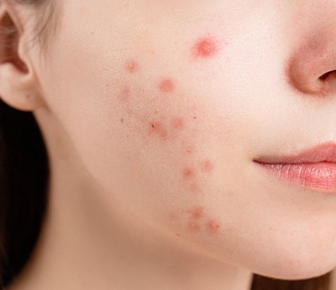 Ideal Concentration of Salicylic Acid to Treat Acne