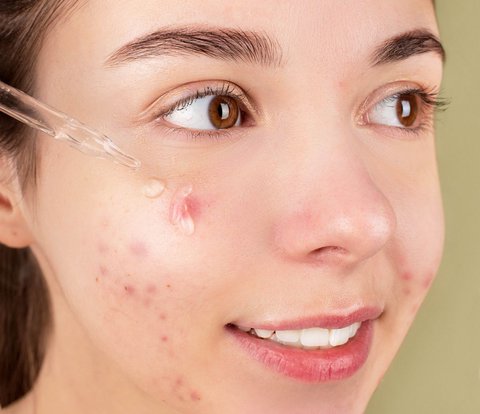Ideal Concentration of Salicylic Acid to Treat Acne