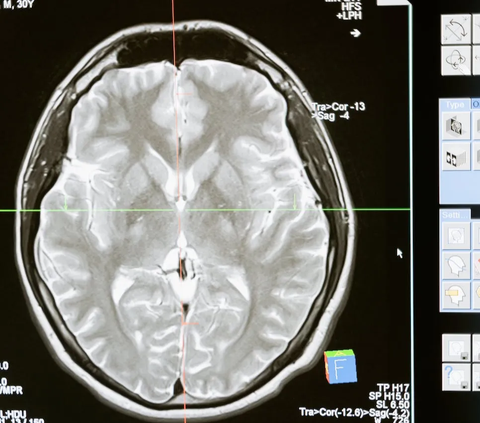 Gejala Stroke Biasanya Muncul Secara Mendadak Berupa Rasa Kesemutan di Satu Sisi