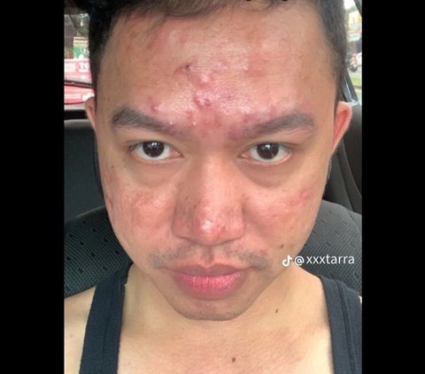Sad Confession of a Man Affected by the Ain Disease, Acne-Prone Face Due to Frequently Uploading Selfies on Social Media