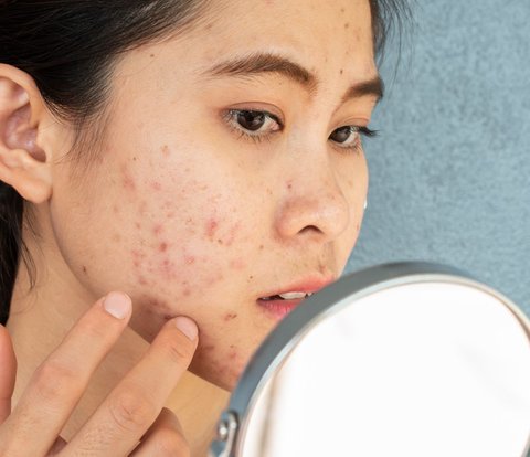 Pitted Skin is Not Effective with Regular Skincare, Doctor Explains