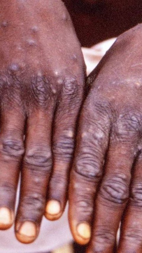 Monkeypox in Jakarta, the Virus Has Arrived on Our Doorstep