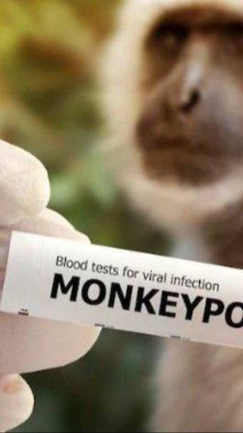 Monkeypox in Jakarta, the Virus Has Arrived on Our Doorstep