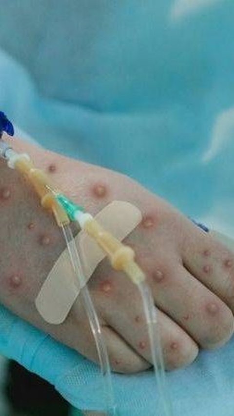 Monkeypox in Jakarta, the Virus Has Arrived on Our Doorstep