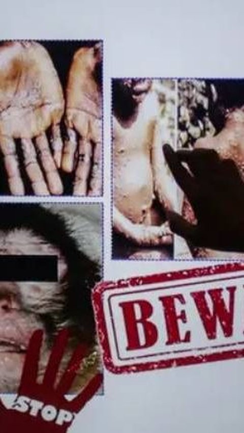 Monkeypox in Jakarta, the Virus Has Arrived on Our Doorstep