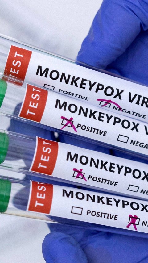 Monkeypox in Jakarta, the Virus Has Arrived on Our Doorstep