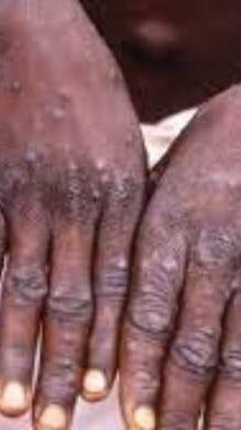 Monkeypox in Jakarta, the Virus Has Arrived on Our Doorstep