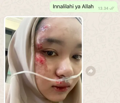 Bride's Face Injured Due to Accident Before Wedding, MUA's Makeup Transformation is Amazing