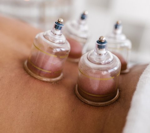 Benefits and Recommended Cupping Time, Prophet's Treatment that is Beneficial for Health