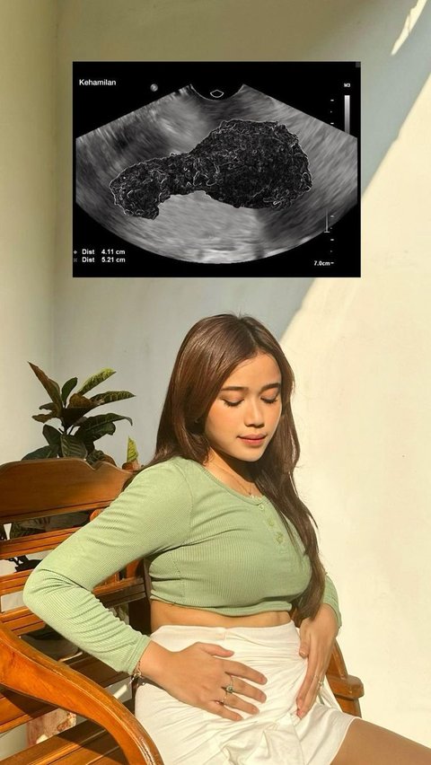 Akhirnya, dia buka suara dengan membagikan foto USG dan berpose seperti ibu hamil sambil memegang perutnya.