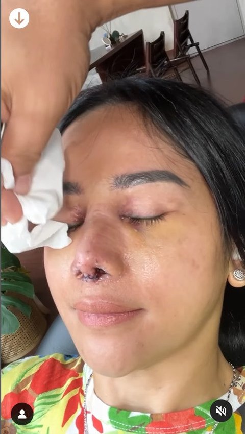 Santai Meski Tuai Cibiran, Potret Farida Nurhan Kembali Oplas Hidung Demi Penampilan Maksimal