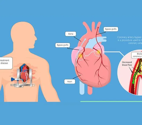 Mengenal TAVI, Bedah Modern Penggantian Katup Jantung