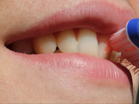 Cara Mengurangi Penumpukan Karang Gigi