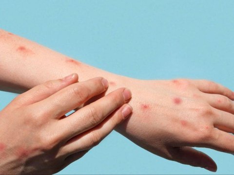 Risiko Komplikasi Herpes Zoster