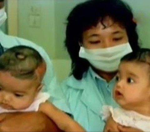 Remember Yuliana-Yuliani, the Conjoined Twins with Joined Heads who Successfully Underwent Surgery? Their Fate Now …