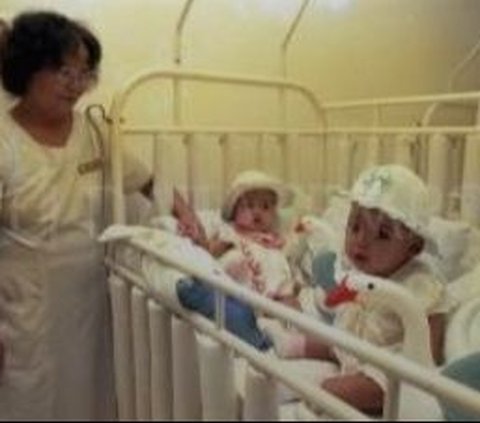 Remember Yuliana-Yuliani, the Conjoined Twins with Joined Heads who Successfully Underwent Surgery? Their Fate Now …