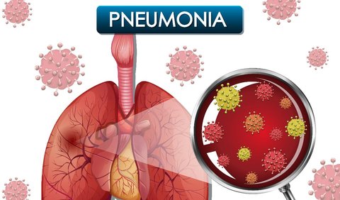 Apa Itu Pneumonia?<br>