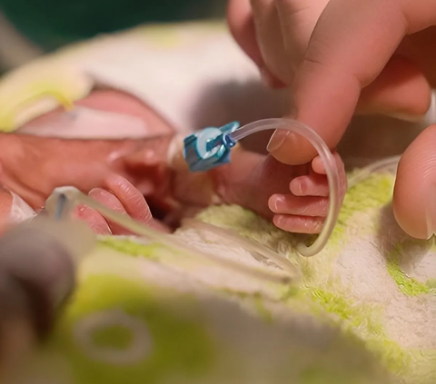 Bayi Prematur di Tasikmalaya Meninggal Usai Dijadikan Konten, Begini Penjelasan Dokter Anak