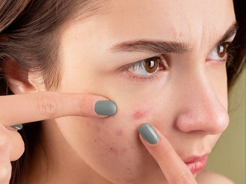 No Need for Expensive Skincare, Consume These Foods to Get Rid of Acne