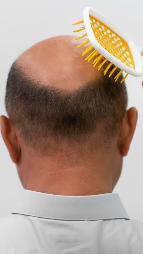 Terapi kanker seperti kemoterapi juga berpotensi menyebabkan kerontokan rambut yang signifikan.