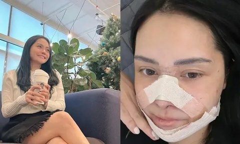 Mawar AFI Oplas Hidung Lagi Implan Pakai Tulang Iga, Ini Potretnya