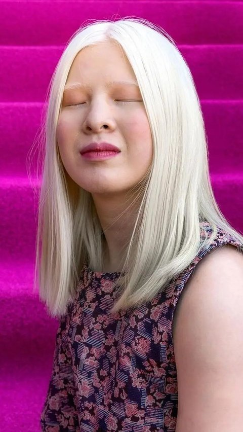 Xueli, model asal China pernah dibuang keluarganya di panti asuhan karena idap albinisme. Siapa sangka, kini Ia malah menjadi model terkenal.