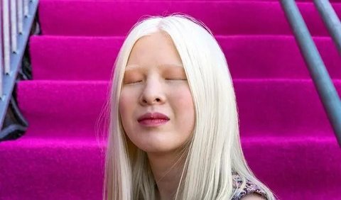 Tidak hanya itu, Xueli, model albino asal China, mengalami kisah yang tak kalah mengharukan.