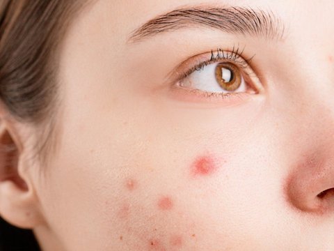 Not Enough to Use Skincare, Acne Complaints Indicate the Need for Doctor's Intervention