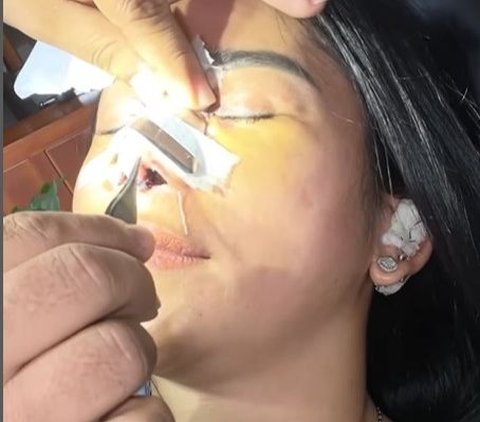 Santai Meski Tuai Cibiran, Potret Farida Nurhan Kembali Oplas Hidung Demi Penampilan Maksimal