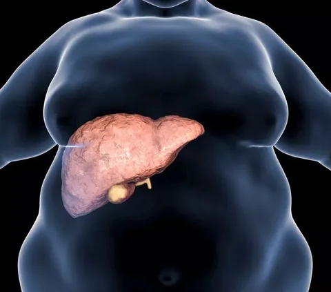 Mengenal Penyakit Fatty Liver dan Gejalanya, Kondisi Lemak Berlebih di Organ Hati