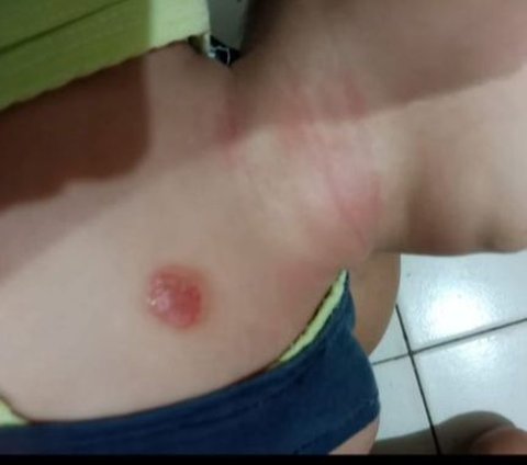 Viral Confession of a Mother Whose Toddler Experienced Severe Rashes After Bathing with Balls