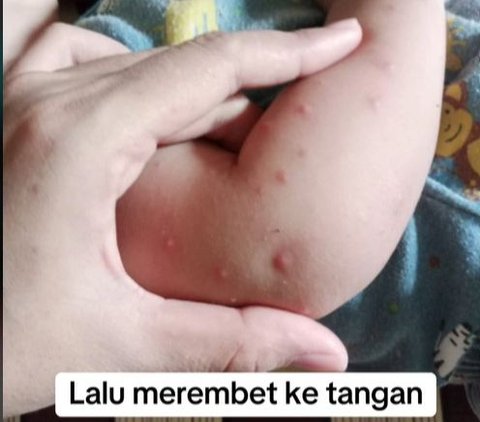 Viral Confession of a Mother Whose Toddler Experienced Severe Rashes After Bathing with Balls