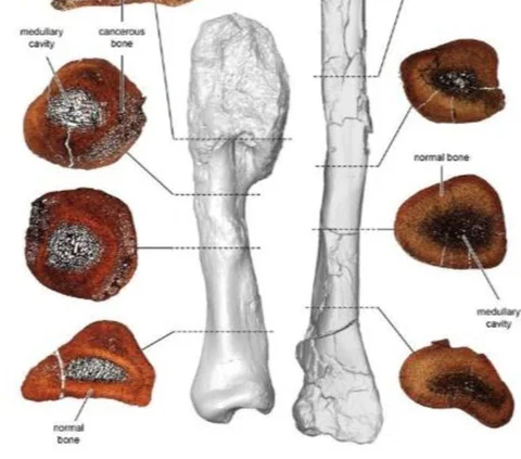 This research becomes the first to confirm the diagnosis of cancer at the cellular level in dinosaur fossils.