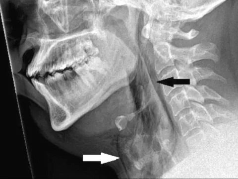 Scary! This Man's Throat Torn from Holding Back a Sneeze, Becomes the First in the World