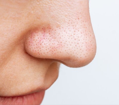 Small Blackheads should not be ignored, immediately overcome with household ingredients
