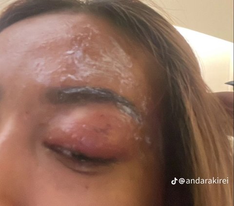 Posting Vacation Photos Ends in Disaster, Woman Gets Affected by Evil Eye After Being Complimented for Her Beauty, Her Eyes Immediately Swell