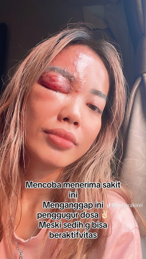 Posting Foto Liburan Berujung Petaka, Wanita Ini Terkena Ain Karena Dipuji Cantik, Matanya Langsung Bengkak<br>