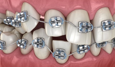 1. Behel Gigi Konvensional (Metal Braces)<br>