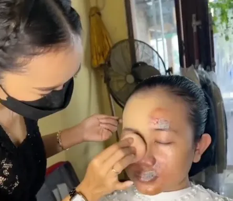 Bride's Face Shattered Due to Accident, Makeup Artist's Makeup Becomes 'Savior' on Wedding Day, the Result is Amazing!