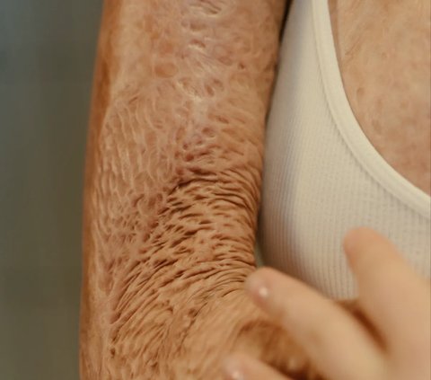 Berikut sejumlah cara yang bisa dilakukan agar luka bakar tidak membekas di kulit dan cepat hilang.