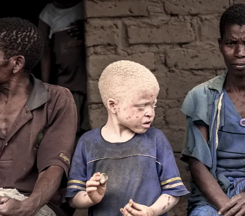 Potret Kampung Albino Tersembunyi di Tanzania, Begini Kondisinya