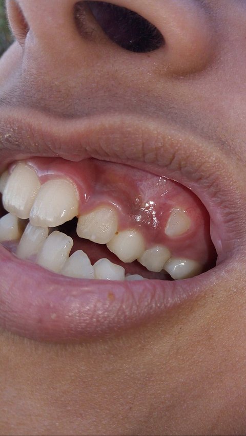 Penyebab Gigi Gingsul, Bahayanya, serta Cara Pencegahan yang Tepat