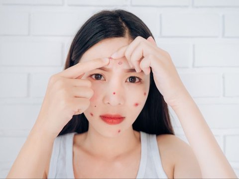 Skin Purging Saat Mencoba Produk Skincare Baru, Bahaya Nggak Sih?