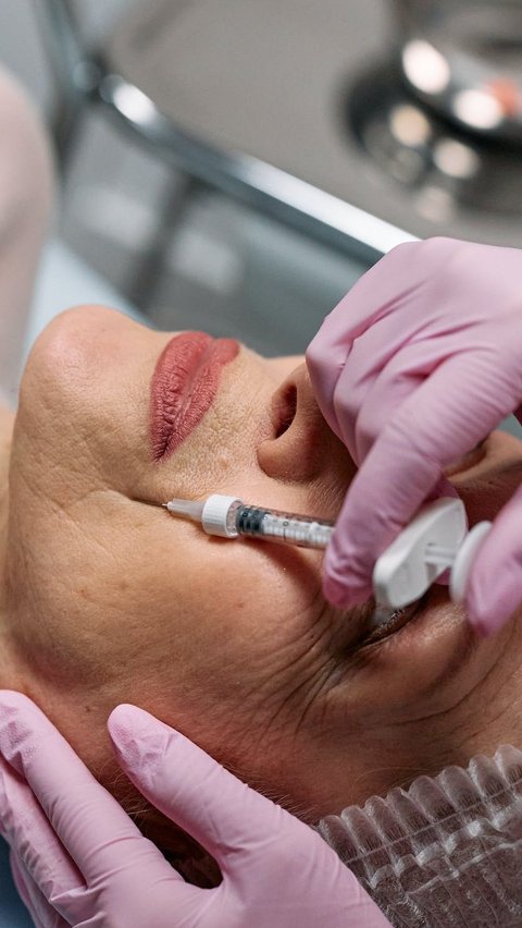 Tak hanya botox, untuk menghilangkan kerutan juga bisa dengan menggunakan metode filler. Yaitu prosedur kosmetik dengan menyuntikkan bahan sintetis atau ke garis, kerutan dan jaringan wajah.