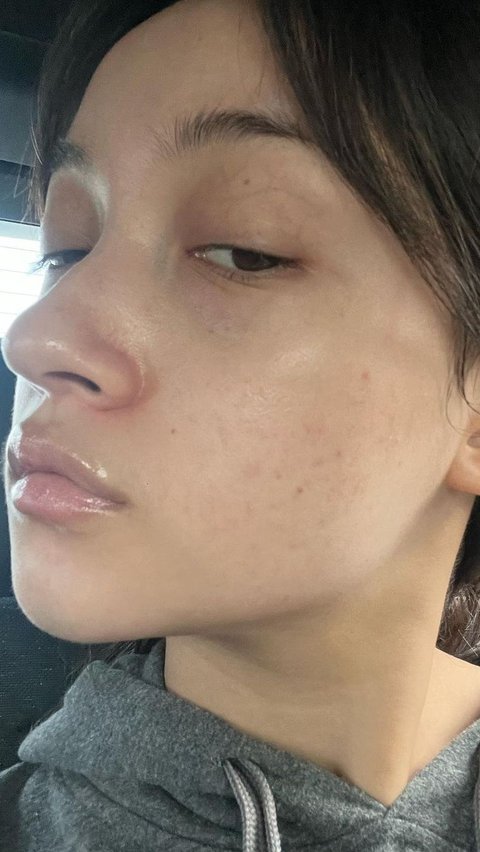 Namun, jerawat yang dimiliki oleh Megan pun cukup parah karena kerap terpapar oleh makeup akibat pekerjaannya. Belum lagi dengan jam tidur dan pola makan tidak teratur yang menyebabkan wajahnya mudah breakout.