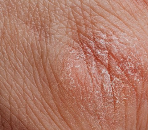 Dermatitis seboroik terkadang bisa hilang dengan sendirinya. Namun, gangguan ini bisa menjadi masalah seumur hidup. Cara mengontrolnya adalah dengan melakukan perawatan kulit.