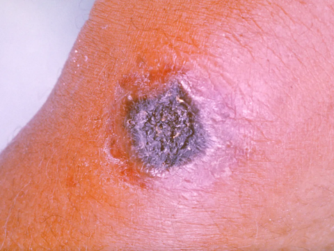 Bisa Masuk Tubuh Manusia Melalui 4 Cara, Ketahui Gejala Terinfeksi Antraks