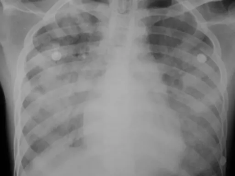 Bisa Masuk Tubuh Manusia Melalui 4 Cara, Ketahui Gejala Terinfeksi Antraks