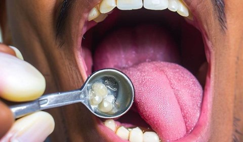Bisakah Karang Gigi Dihilangkan Secara Alami?